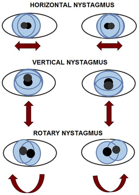 post rotary nystagmus soft sign test|nystagmus test horizontal vs horizontal.